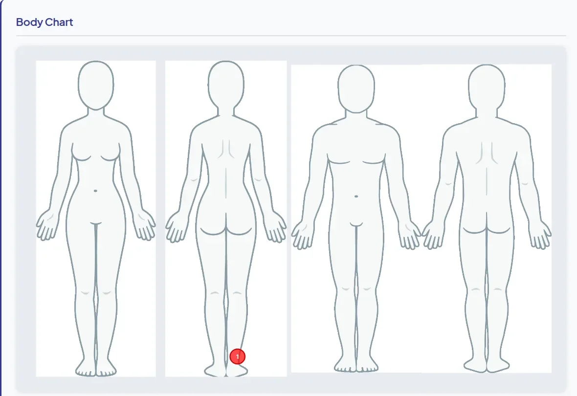 A body map with a mark on the right heel, shown on front and back body outlines